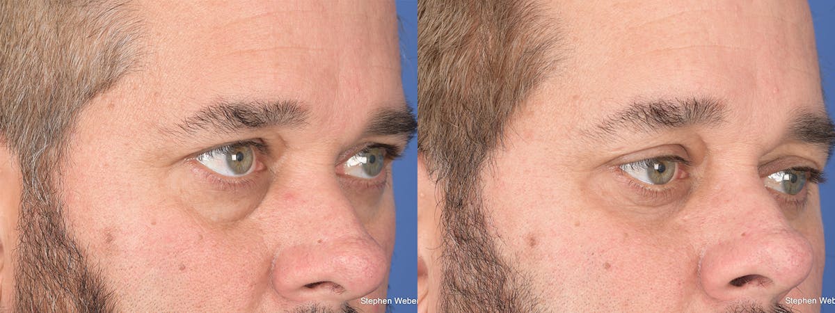 Blepharoplasty Before & After Gallery - Patient 381812 - Image 4