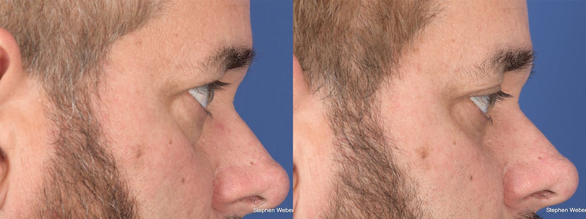 Blepharoplasty Before & After Gallery - Patient 381812 - Image 5