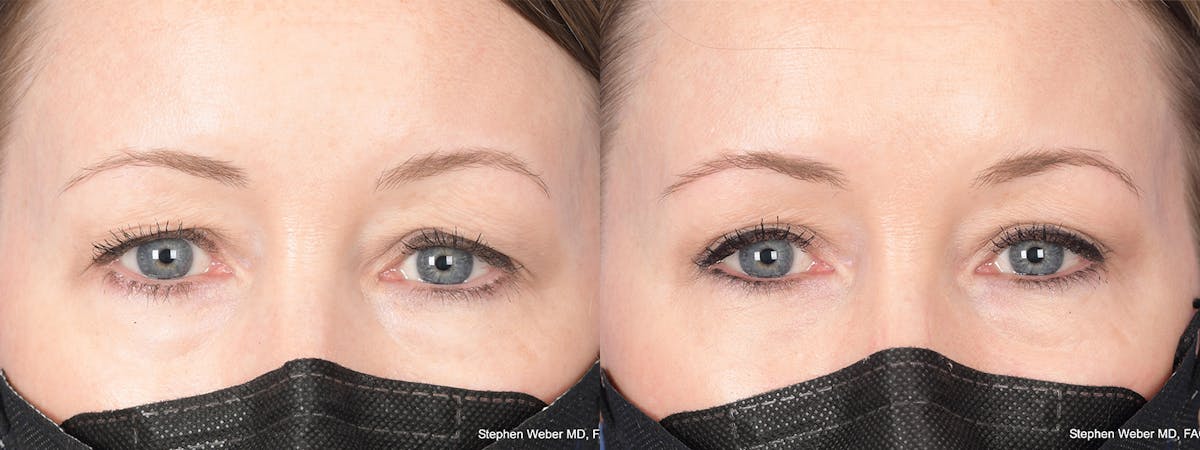 Blepharoplasty Before & After Gallery - Patient 388145 - Image 1