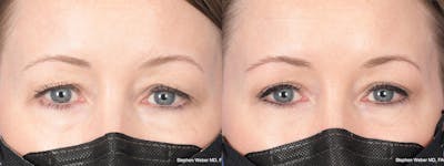 Blepharoplasty Before & After Gallery - Patient 388145 - Image 1