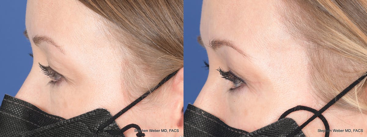 Blepharoplasty Before & After Gallery - Patient 388145 - Image 2
