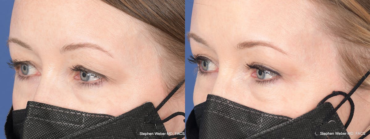 Blepharoplasty Before & After Gallery - Patient 388145 - Image 3