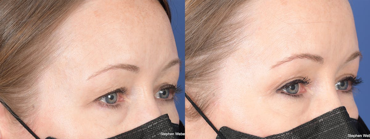 Blepharoplasty Before & After Gallery - Patient 388145 - Image 4
