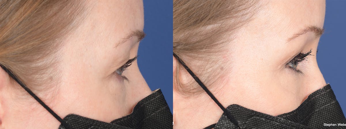 Blepharoplasty Before & After Gallery - Patient 388145 - Image 5