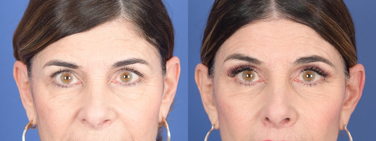 Blepharoplasty Before & After Gallery - Patient 122043 - Image 1