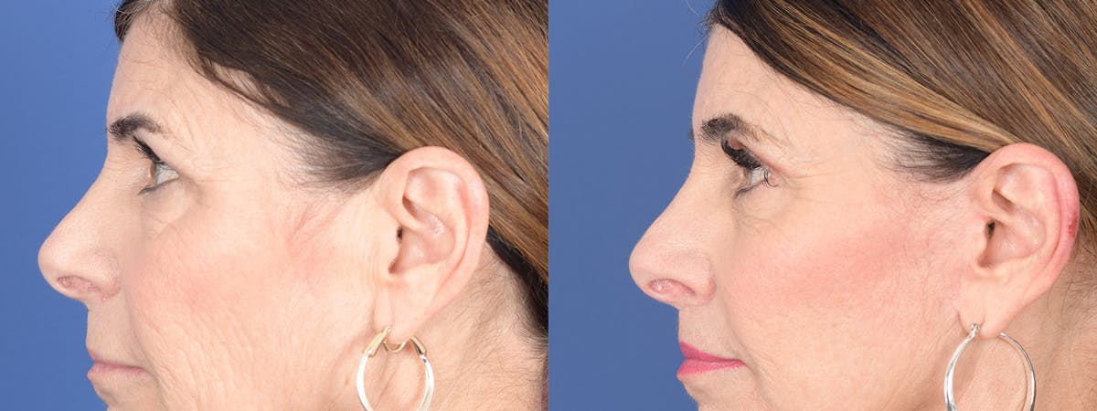 Blepharoplasty Before & After Gallery - Patient 122043 - Image 2