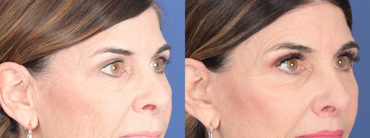 Blepharoplasty Before & After Gallery - Patient 122043 - Image 3