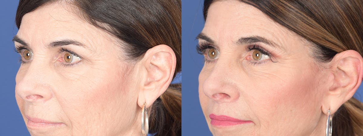 Blepharoplasty Before & After Gallery - Patient 122043 - Image 4