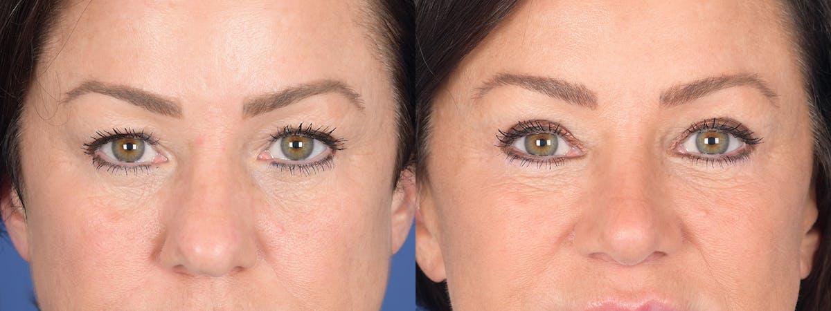 Blepharoplasty Before & After Gallery - Patient 275822 - Image 1