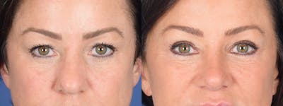 Blepharoplasty Before & After Gallery - Patient 275822 - Image 1