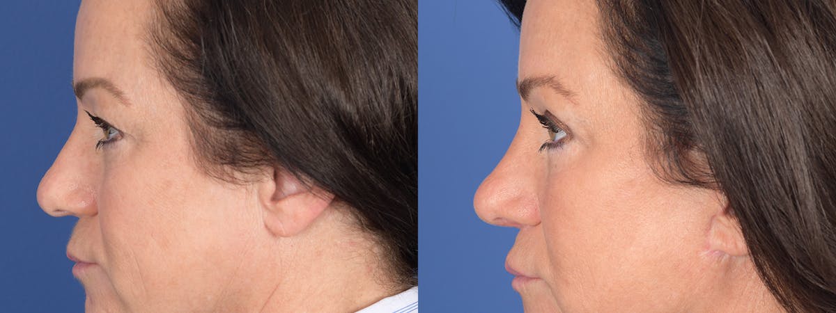 Blepharoplasty Before & After Gallery - Patient 275822 - Image 2