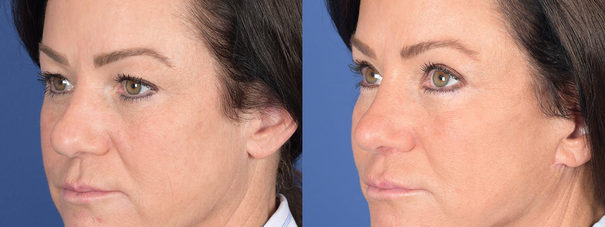 Blepharoplasty Before & After Gallery - Patient 275822 - Image 3