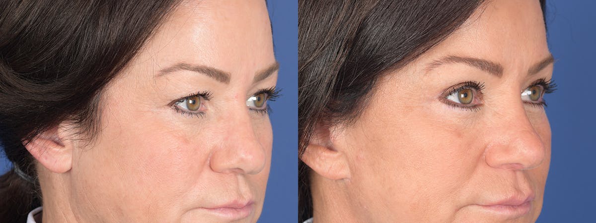 Blepharoplasty Before & After Gallery - Patient 275822 - Image 4