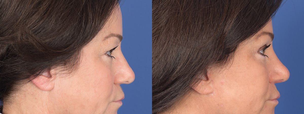 Blepharoplasty Before & After Gallery - Patient 275822 - Image 5