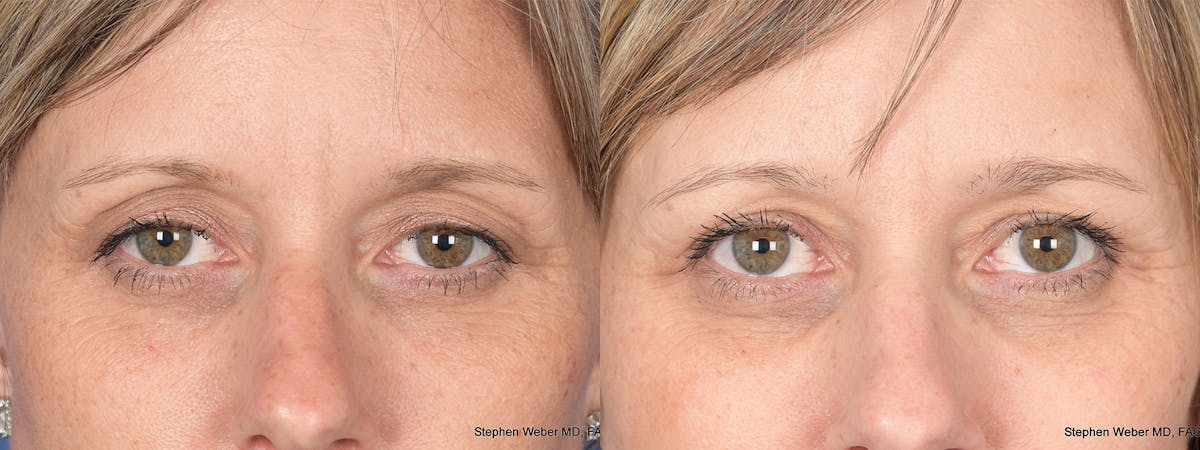 Blepharoplasty Before & After Gallery - Patient 113142 - Image 1