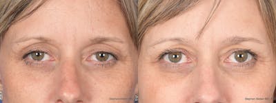 Blepharoplasty Before & After Gallery - Patient 113142 - Image 1