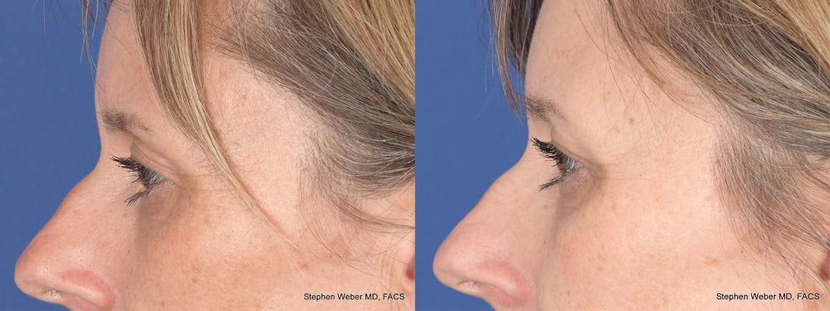 Blepharoplasty Before & After Gallery - Patient 113142 - Image 2