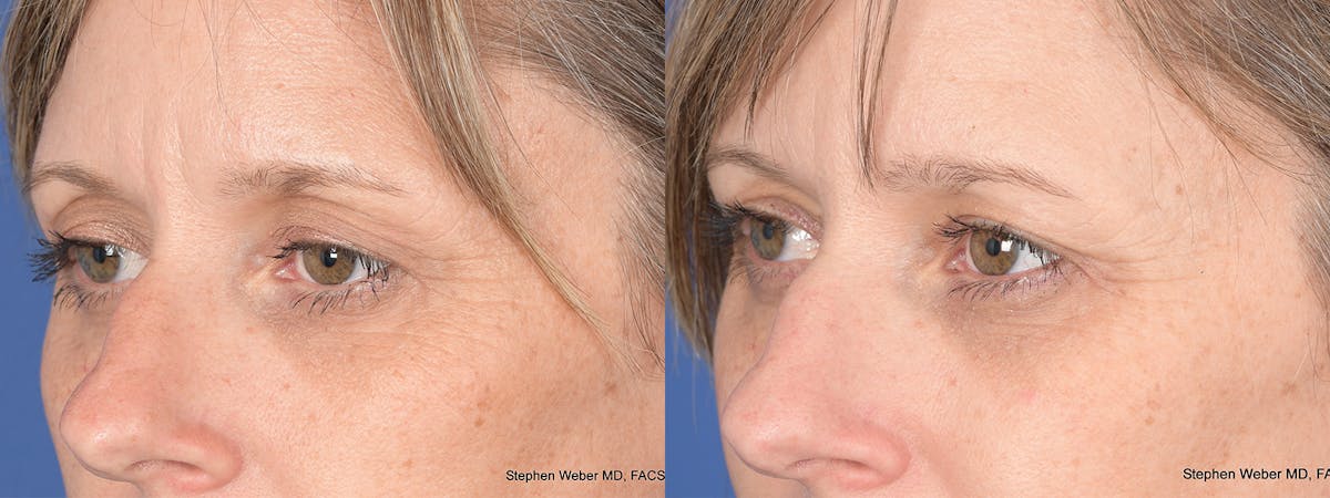 Blepharoplasty Before & After Gallery - Patient 113142 - Image 3