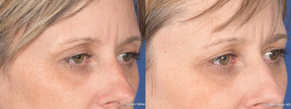 Blepharoplasty Before & After Gallery - Patient 113142 - Image 4