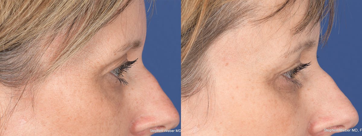 Blepharoplasty Before & After Gallery - Patient 113142 - Image 5