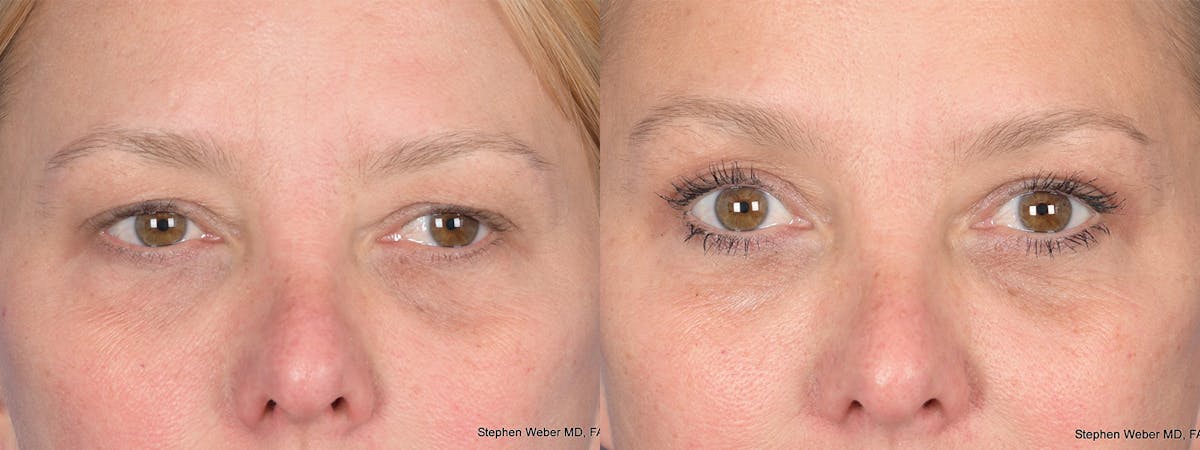 Blepharoplasty Before & After Gallery - Patient 221932 - Image 1
