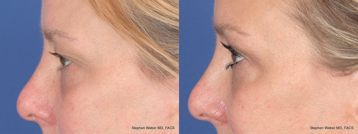 Blepharoplasty Before & After Gallery - Patient 221932 - Image 2
