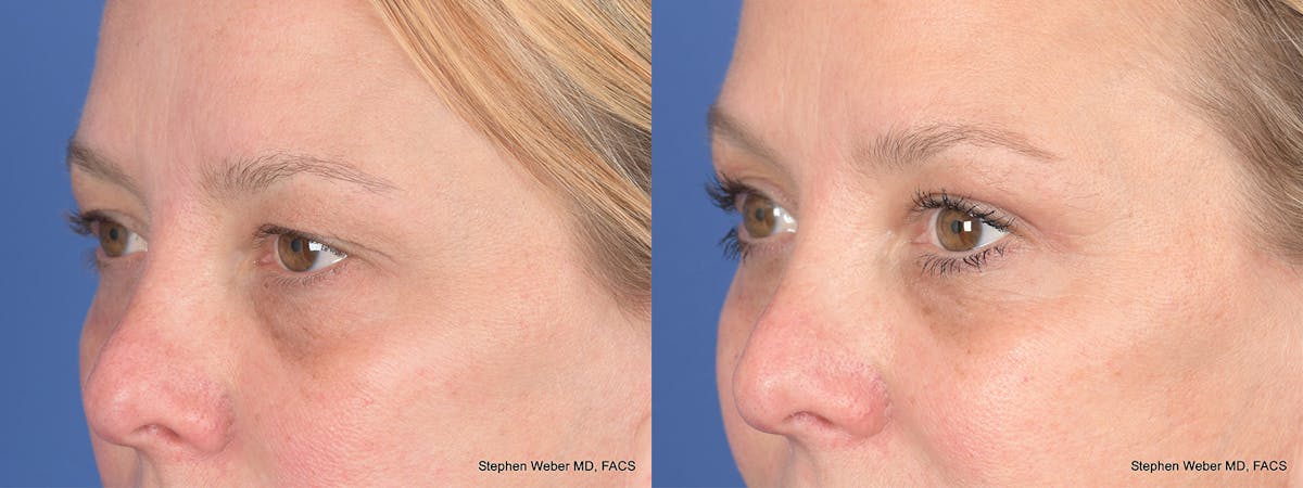 Blepharoplasty Before & After Gallery - Patient 221932 - Image 3