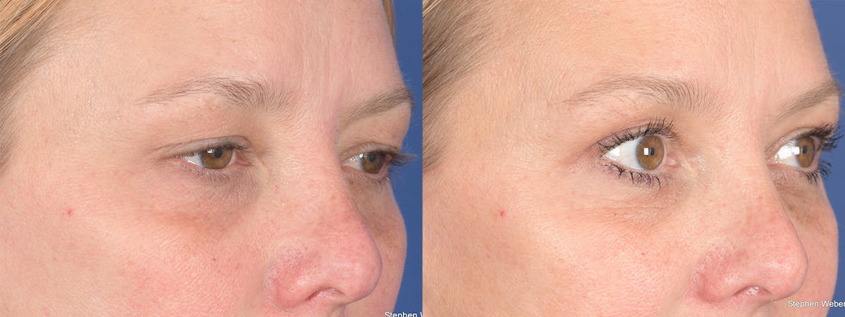 Blepharoplasty Before & After Gallery - Patient 221932 - Image 4