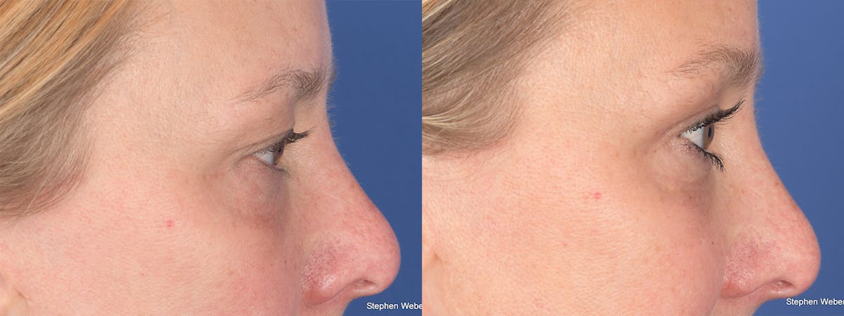 Blepharoplasty Before & After Gallery - Patient 221932 - Image 5