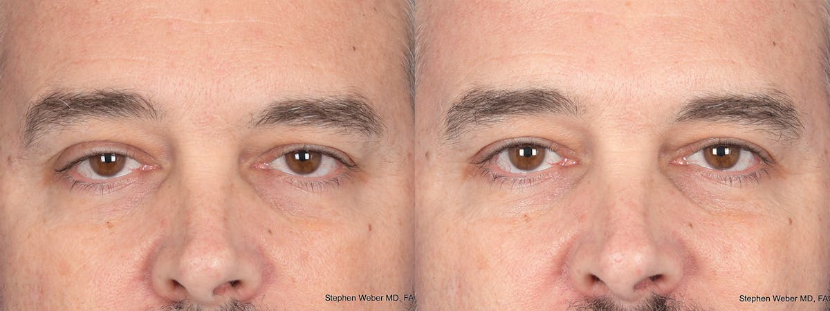 Blepharoplasty Before & After Gallery - Patient 417139 - Image 1