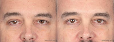 Blepharoplasty Before & After Gallery - Patient 417139 - Image 1