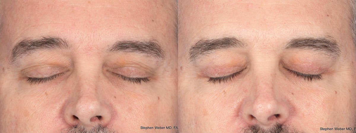 Blepharoplasty Before & After Gallery - Patient 417139 - Image 2