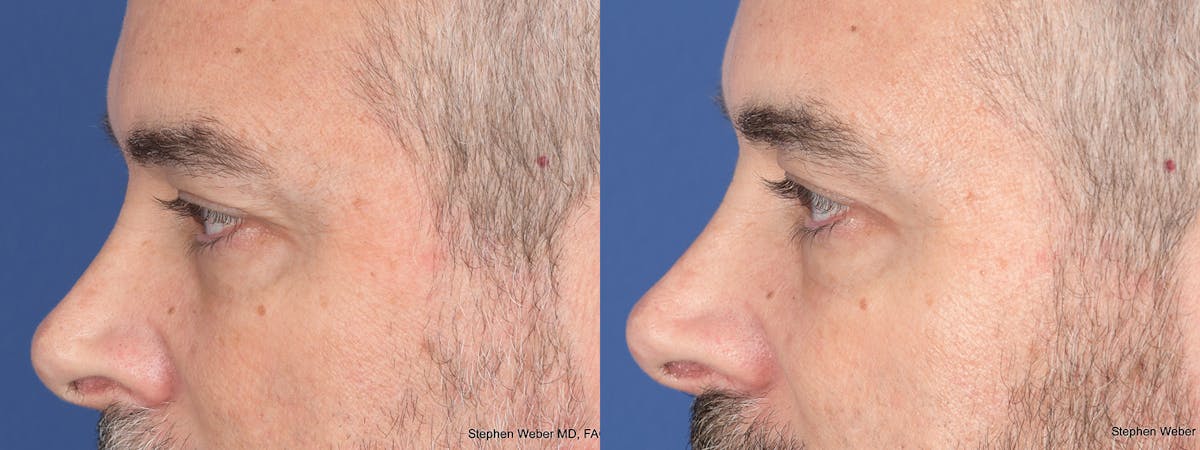 Blepharoplasty Before & After Gallery - Patient 417139 - Image 3