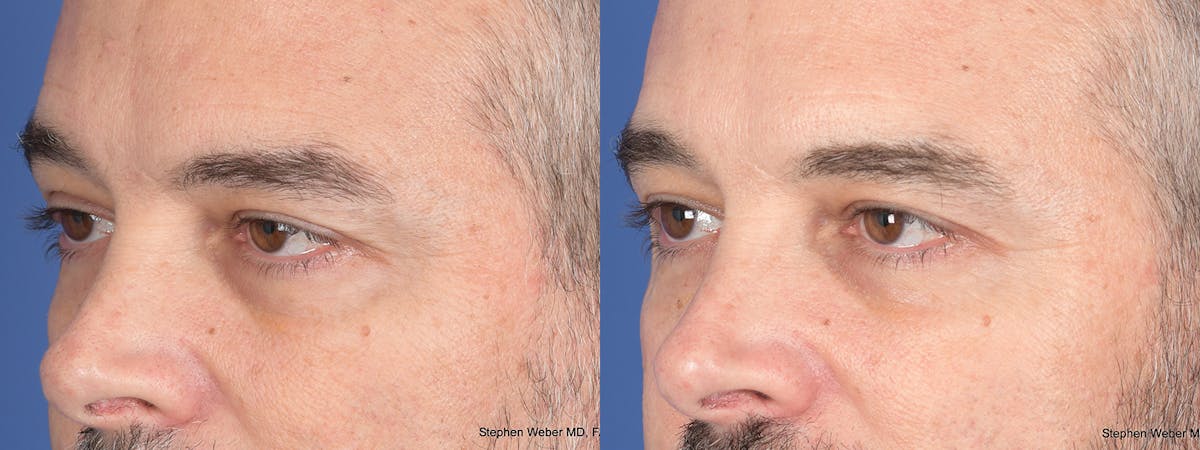 Blepharoplasty Before & After Gallery - Patient 417139 - Image 4