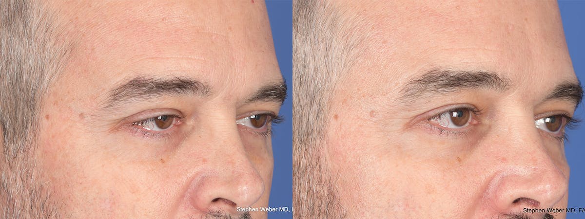 Blepharoplasty Before & After Gallery - Patient 417139 - Image 5