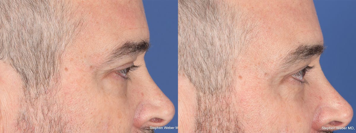 Blepharoplasty Before & After Gallery - Patient 417139 - Image 6