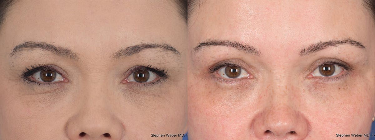 Blepharoplasty Before & After Gallery - Patient 112931 - Image 1
