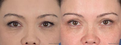 Blepharoplasty Before & After Gallery - Patient 112931 - Image 1
