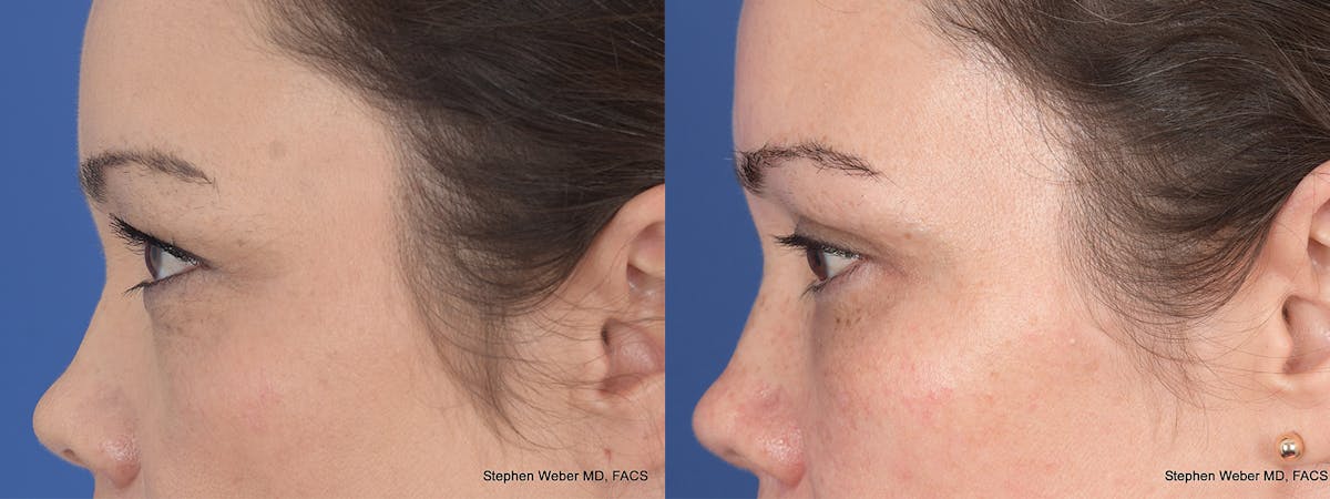Blepharoplasty Before & After Gallery - Patient 112931 - Image 2