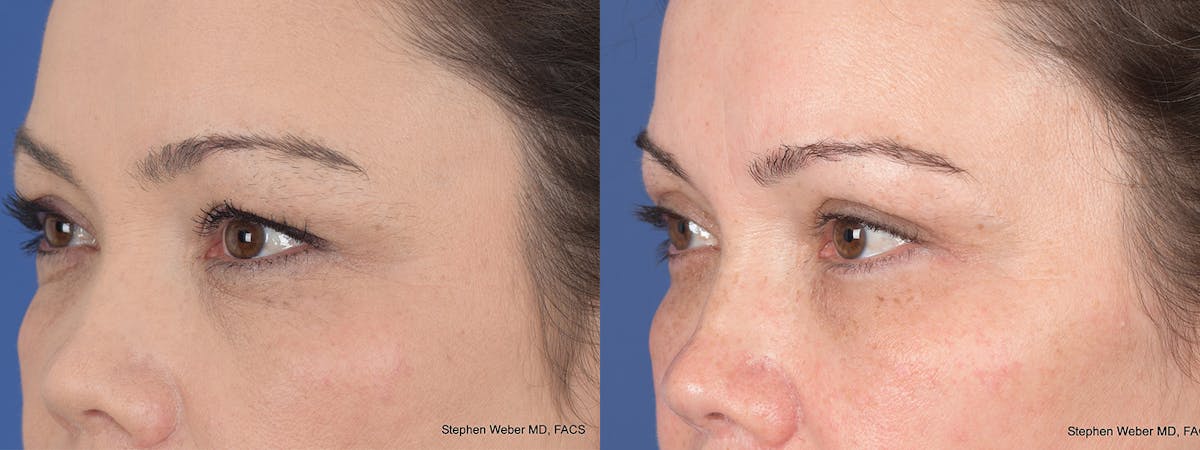 Blepharoplasty Before & After Gallery - Patient 112931 - Image 3