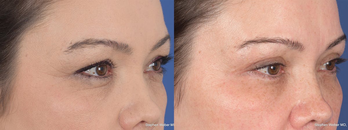 Blepharoplasty Before & After Gallery - Patient 112931 - Image 4