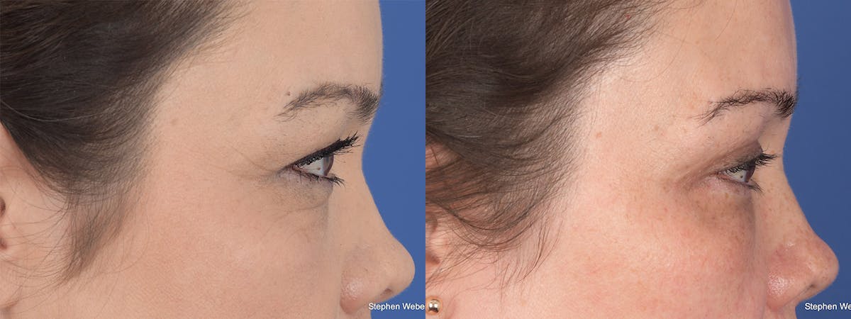 Blepharoplasty Before & After Gallery - Patient 112931 - Image 5