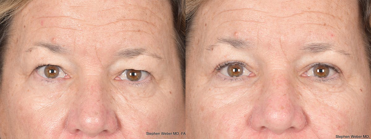 Blepharoplasty Before & After Gallery - Patient 111233 - Image 1