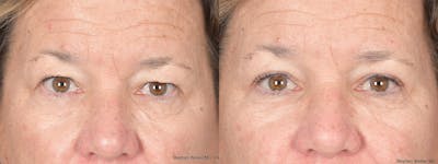 Blepharoplasty Before & After Gallery - Patient 111233 - Image 1