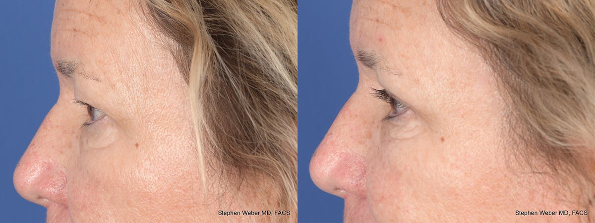 Blepharoplasty Before & After Gallery - Patient 111233 - Image 2