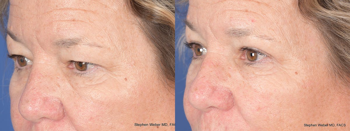 Blepharoplasty Before & After Gallery - Patient 111233 - Image 3