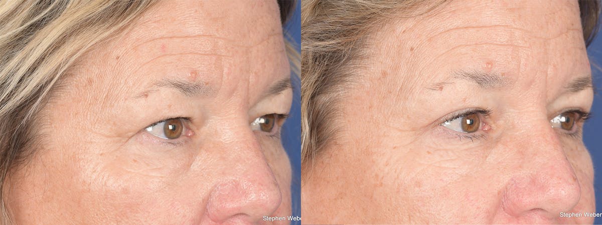 Blepharoplasty Before & After Gallery - Patient 111233 - Image 4