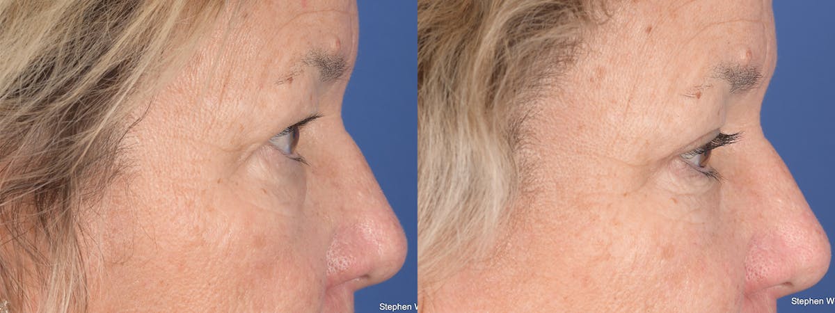 Blepharoplasty Before & After Gallery - Patient 111233 - Image 5