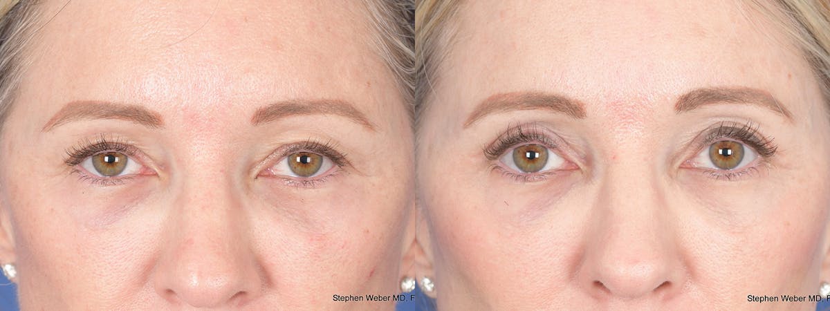 Blepharoplasty Before & After Gallery - Patient 227859 - Image 1