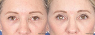 Blepharoplasty Before & After Gallery - Patient 227859 - Image 1